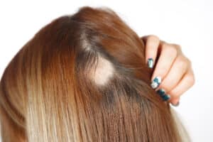 Woman shows a bald spot from alopecia areata in Berkeley, CA